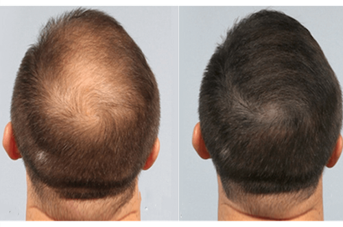 Hair Loss Solution - Mississauga - Oakville